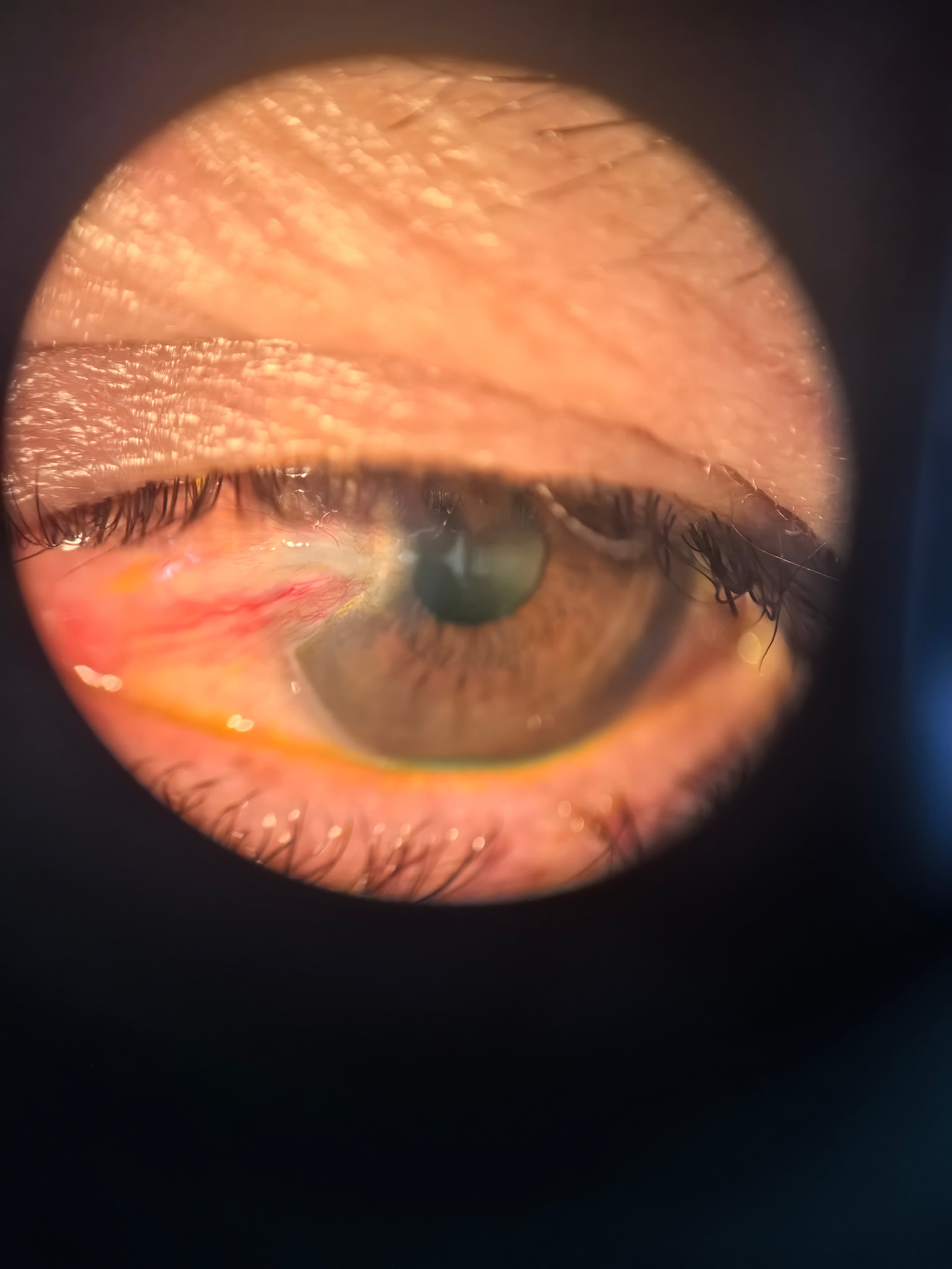 Carnosidad ocular con vasos sanguíneos avanzando sobre la córnea
